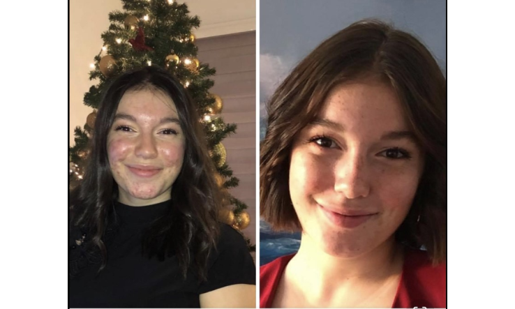 Comment Charlotte -17 ans- a résolu son acné avec son rituel beauté